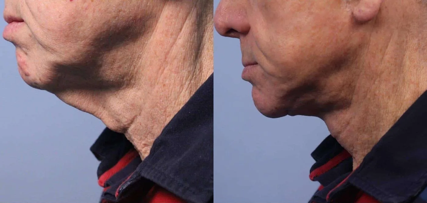 Neck Lift - Before and After Gallery - Patient Photo 40