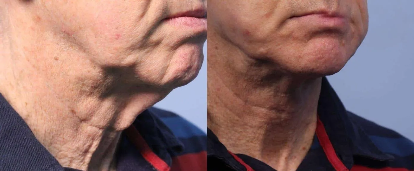 Neck Lift - Before and After Gallery - Patient Photo 41