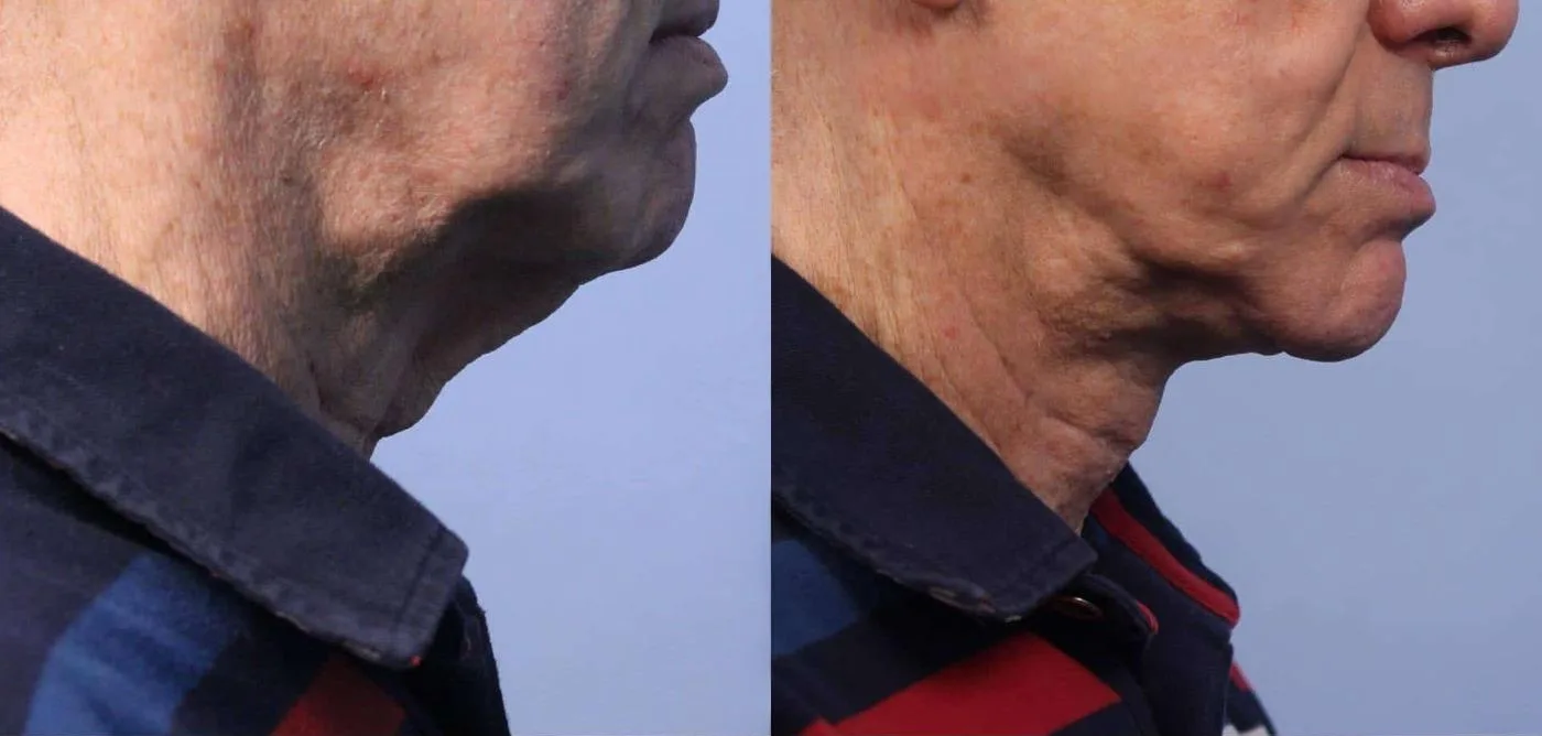 Neck Lift - Before and After Gallery - Patient Photo 42