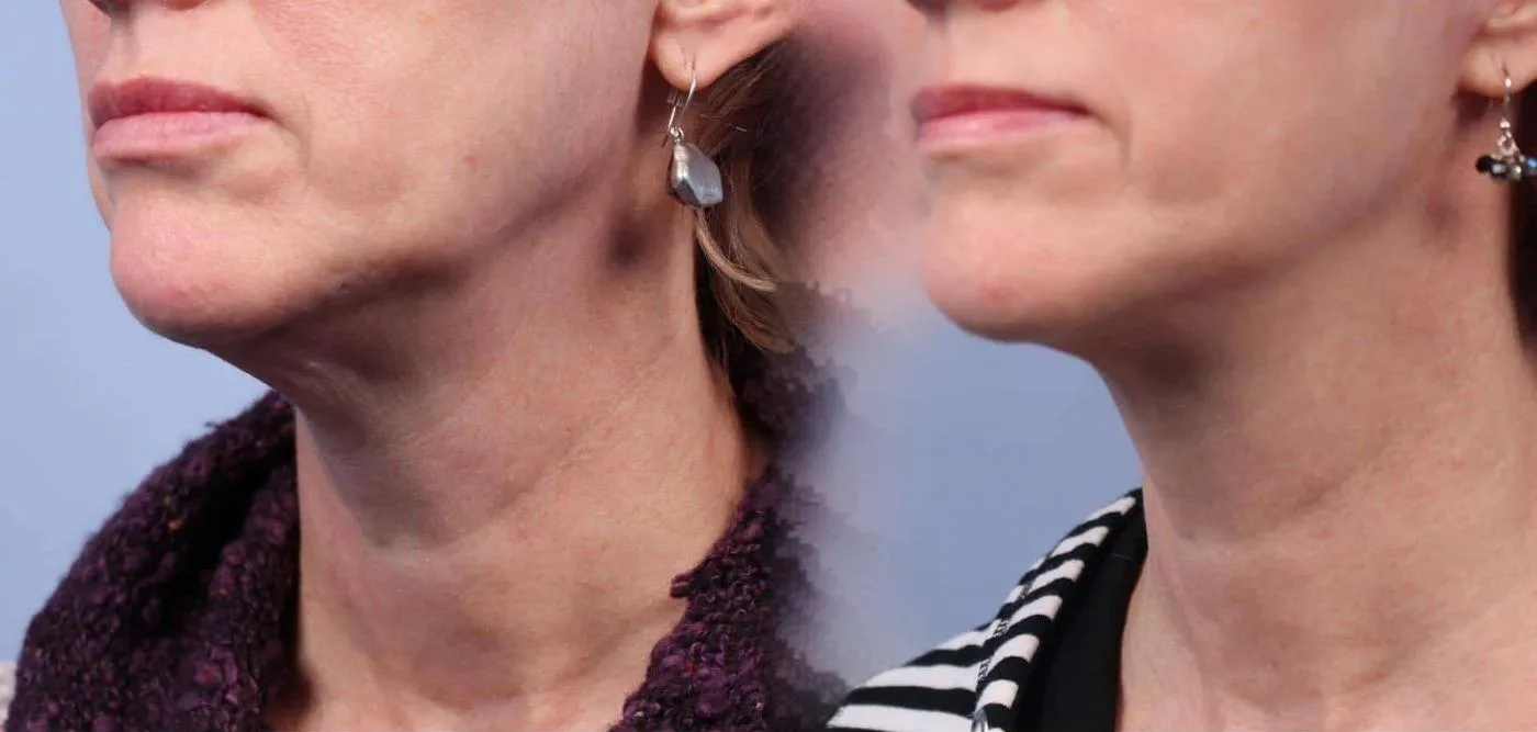 Neck Lift - Before and After Gallery - Patient Photo 43