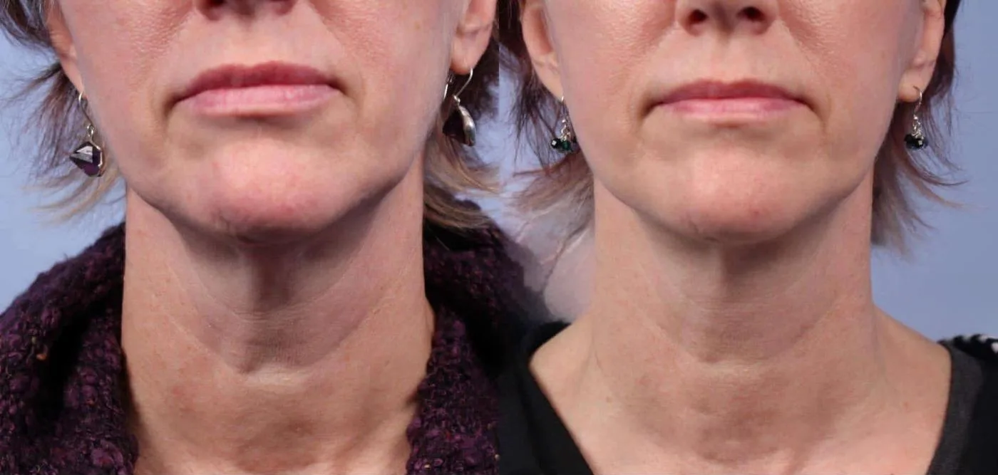 Neck Lift - Before and After Gallery - Patient Photo 44