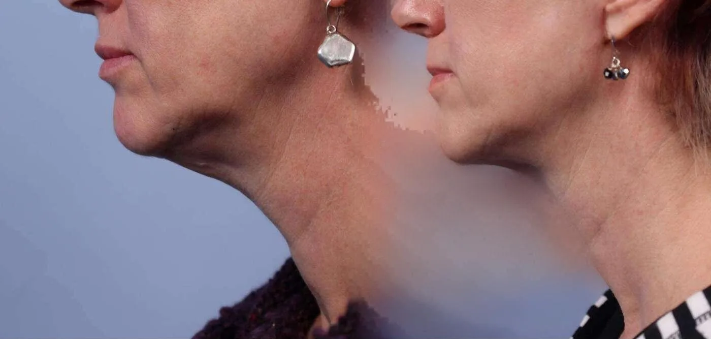 Neck Lift - Before and After Gallery - Patient Photo 45