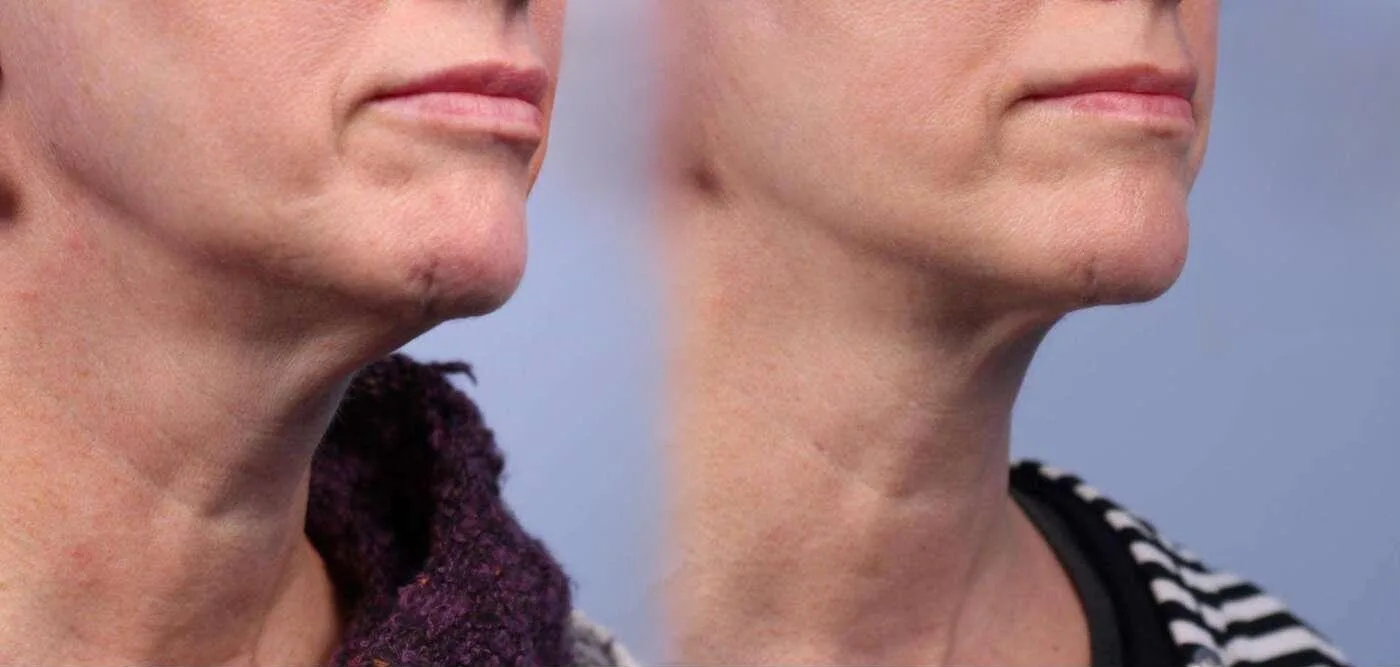 Neck Lift - Before and After Gallery - Patient Photo 46
