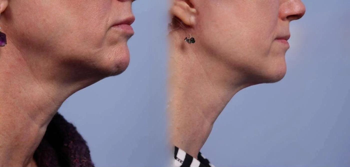 Neck Lift - Before and After Gallery - Patient Photo 47