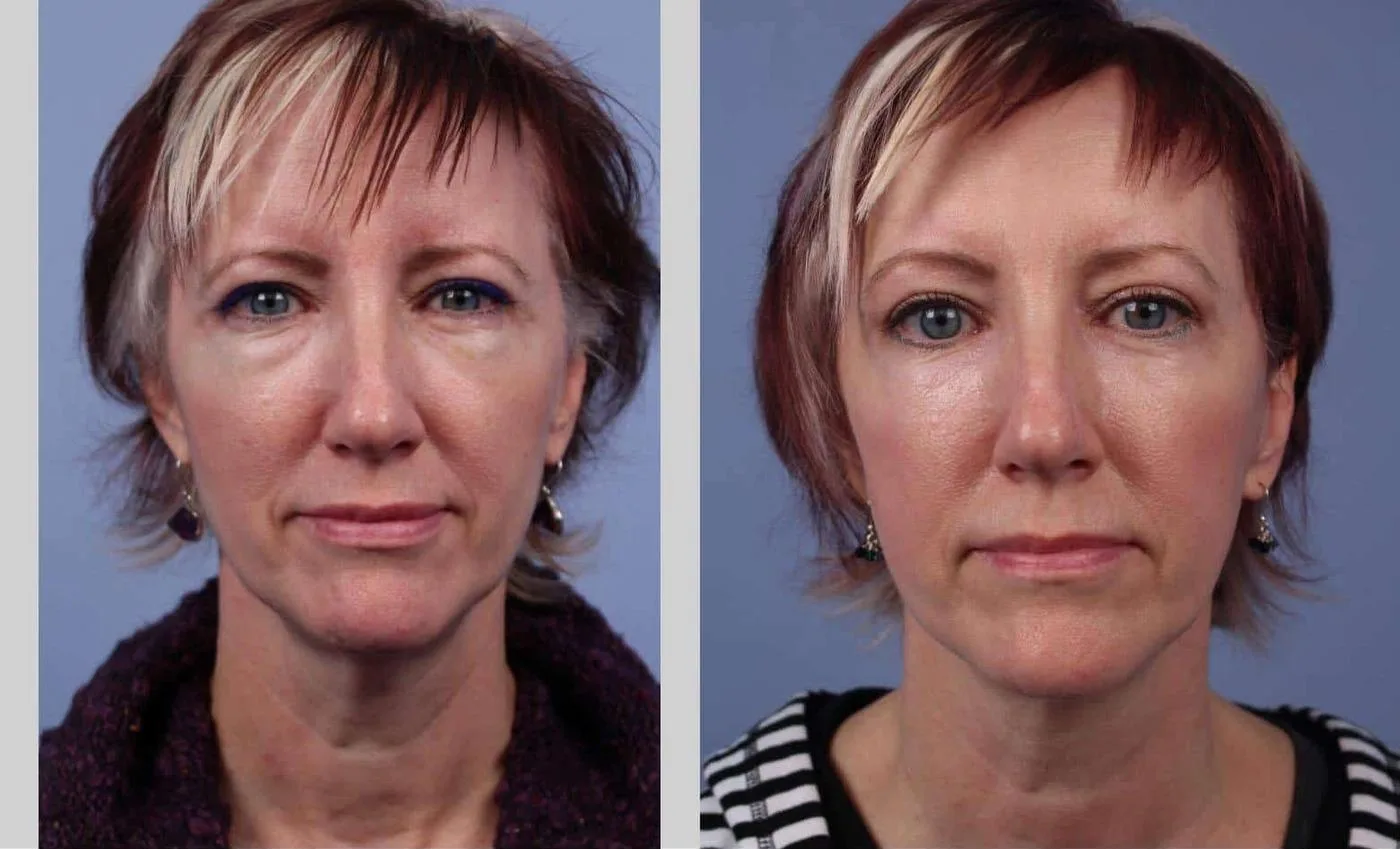 Neck Lift - Before and After Gallery - Patient Photo 48