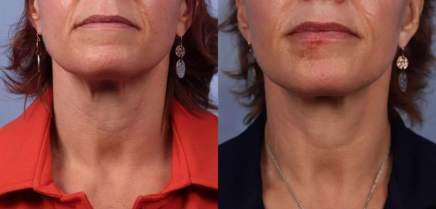 Neck Lift - Before and After Gallery - Patient Photo 49
