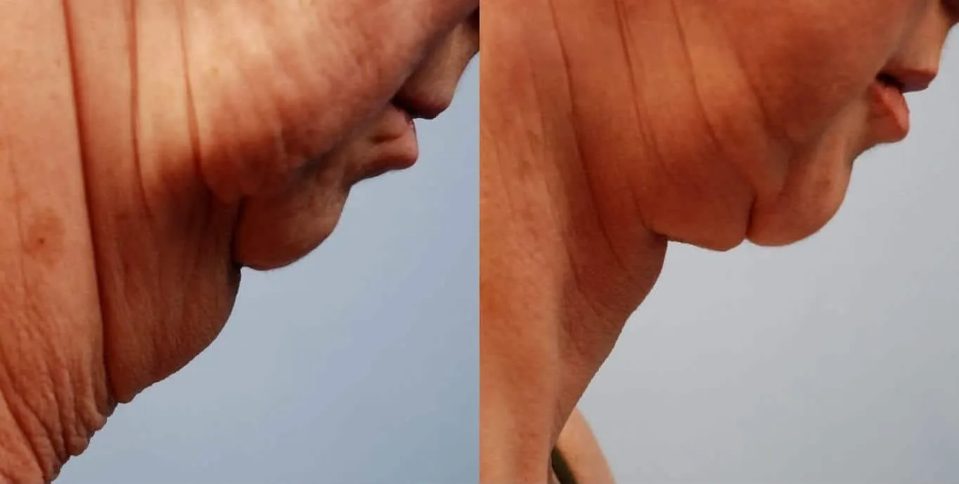 Neck Lift - Before and After Gallery - Patient Photo 5