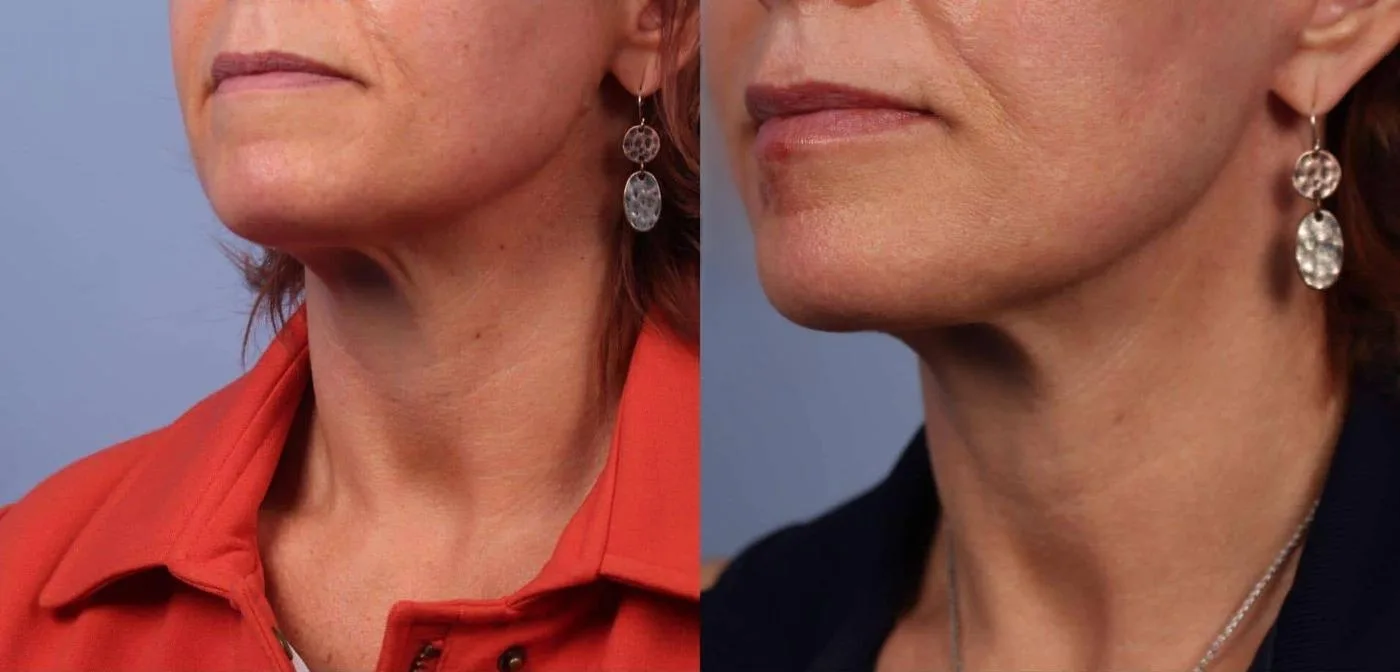 Neck Lift - Before and After Gallery - Patient Photo 50