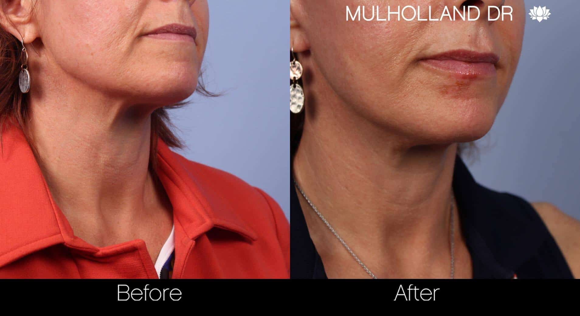 Neck Lift - Before and After Gallery - Patient Photo 51
