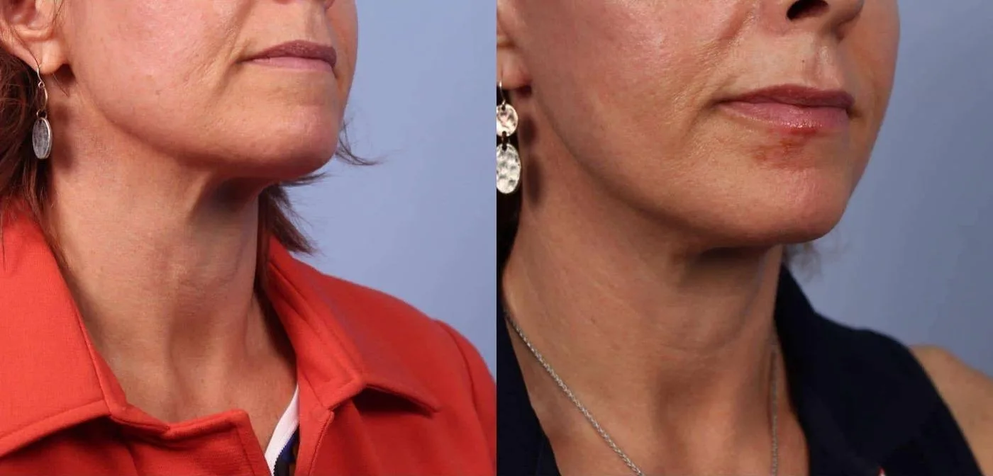 Neck Lift - Before and After Gallery - Patient Photo 51
