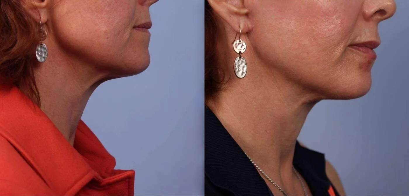 Neck Lift - Before and After Gallery - Patient Photo 52