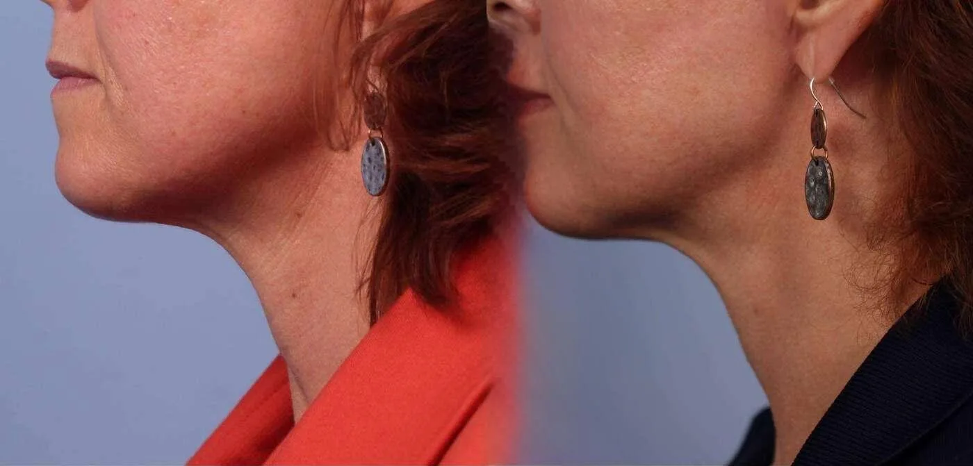 Neck Lift - Before and After Gallery - Patient Photo 53