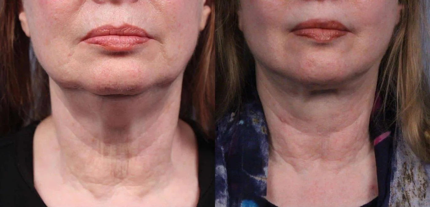 Neck Lift - Before and After Gallery - Patient Photo 54