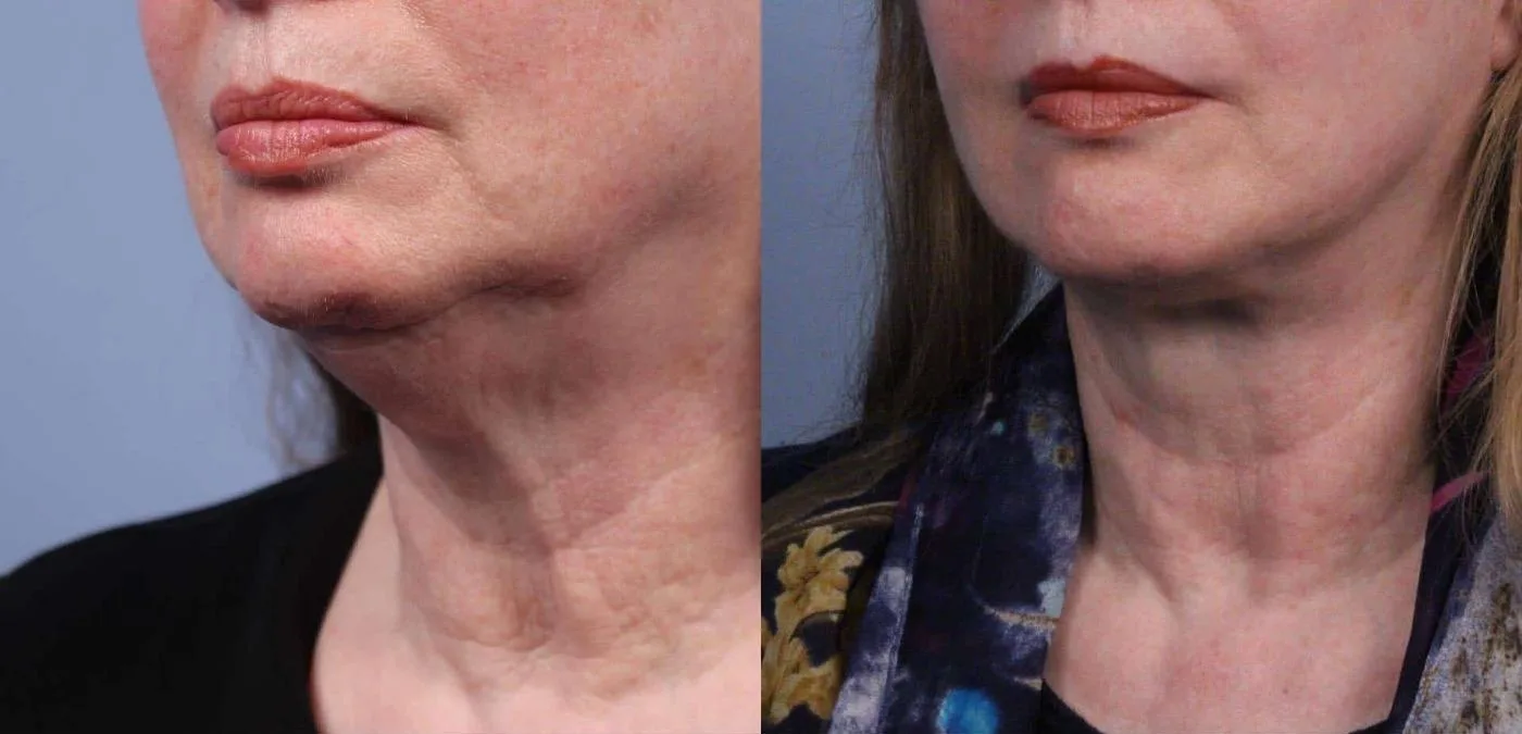 Neck Lift - Before and After Gallery - Patient Photo 55
