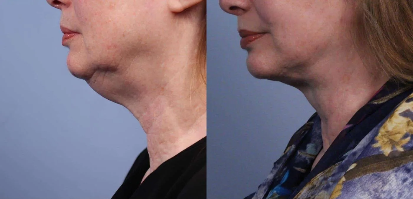 Neck Lift - Before and After Gallery - Patient Photo 56