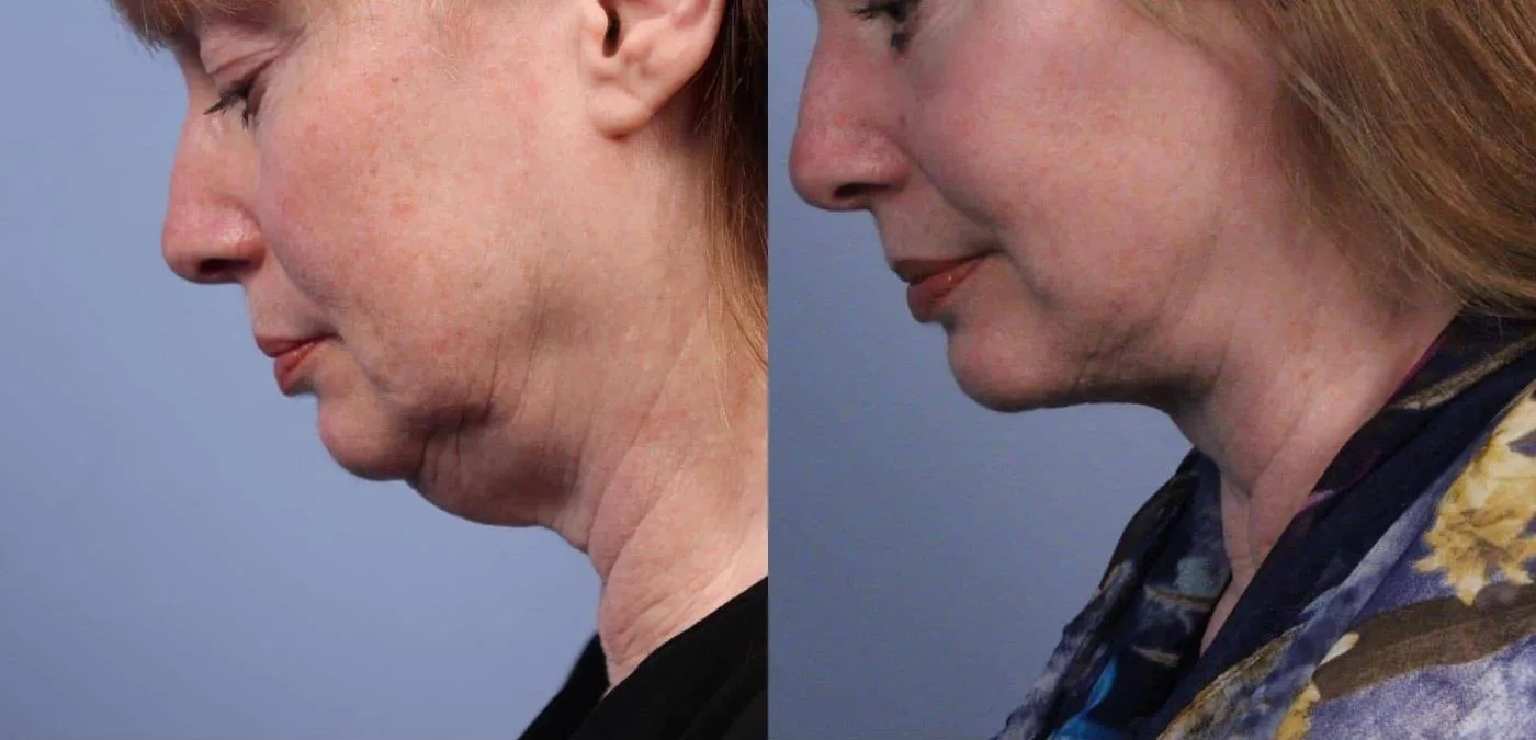 Neck Lift - Before and After Gallery - Patient Photo 57