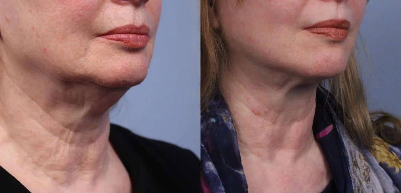 Neck Lift - Before and After Gallery - Patient Photo 58