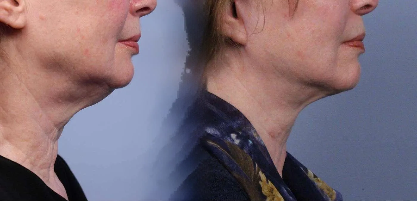 Neck Lift - Before and After Gallery - Patient Photo 59