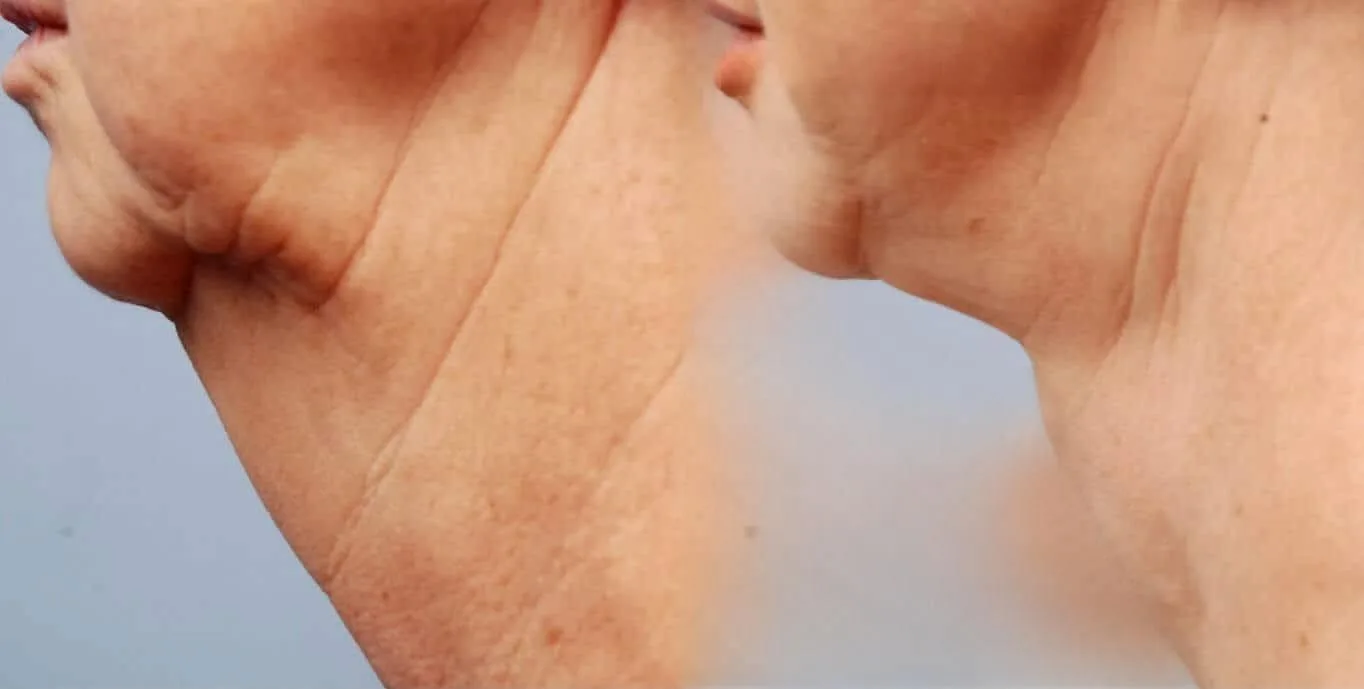 Neck Lift - Before and After Gallery - Patient Photo 6