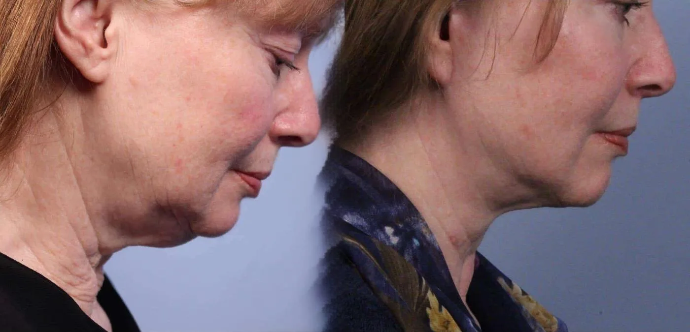 Neck Lift - Before and After Gallery - Patient Photo 60