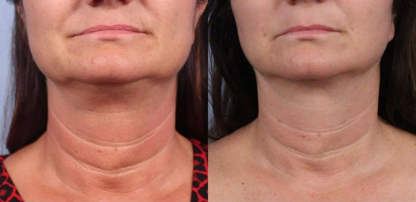 Neck Lift - Before and After Gallery - Patient Photo 61