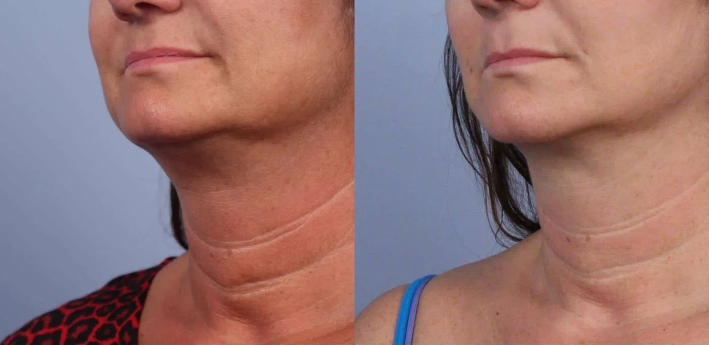 Neck Lift - Before and After Gallery - Patient Photo 62