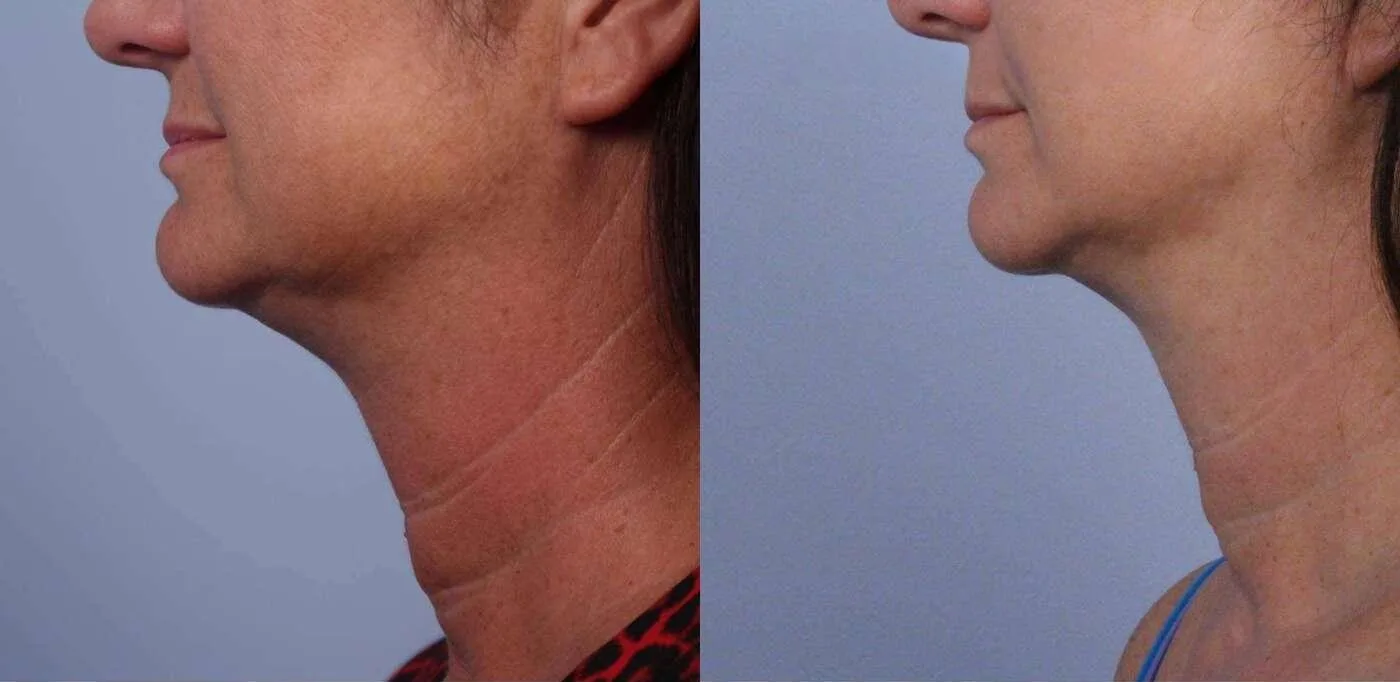 Neck Lift - Before and After Gallery - Patient Photo 63