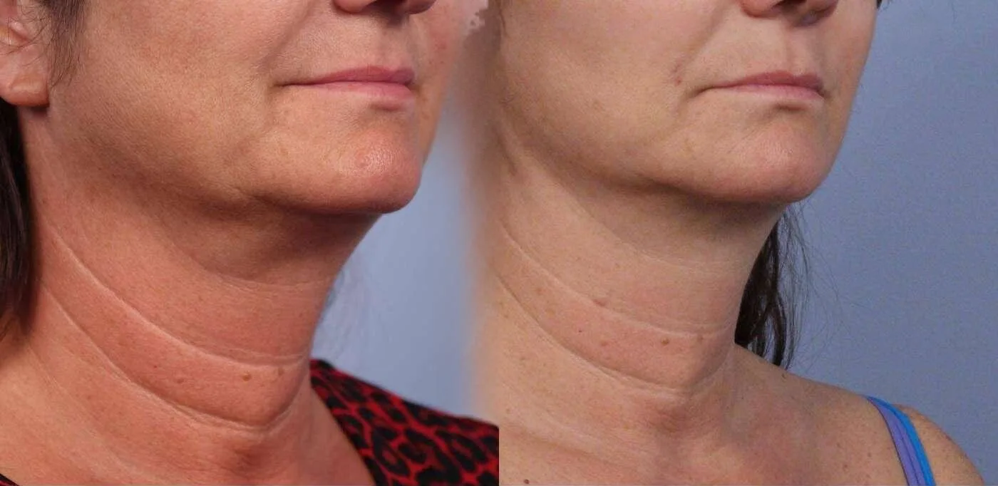Neck Lift - Before and After Gallery - Patient Photo 64