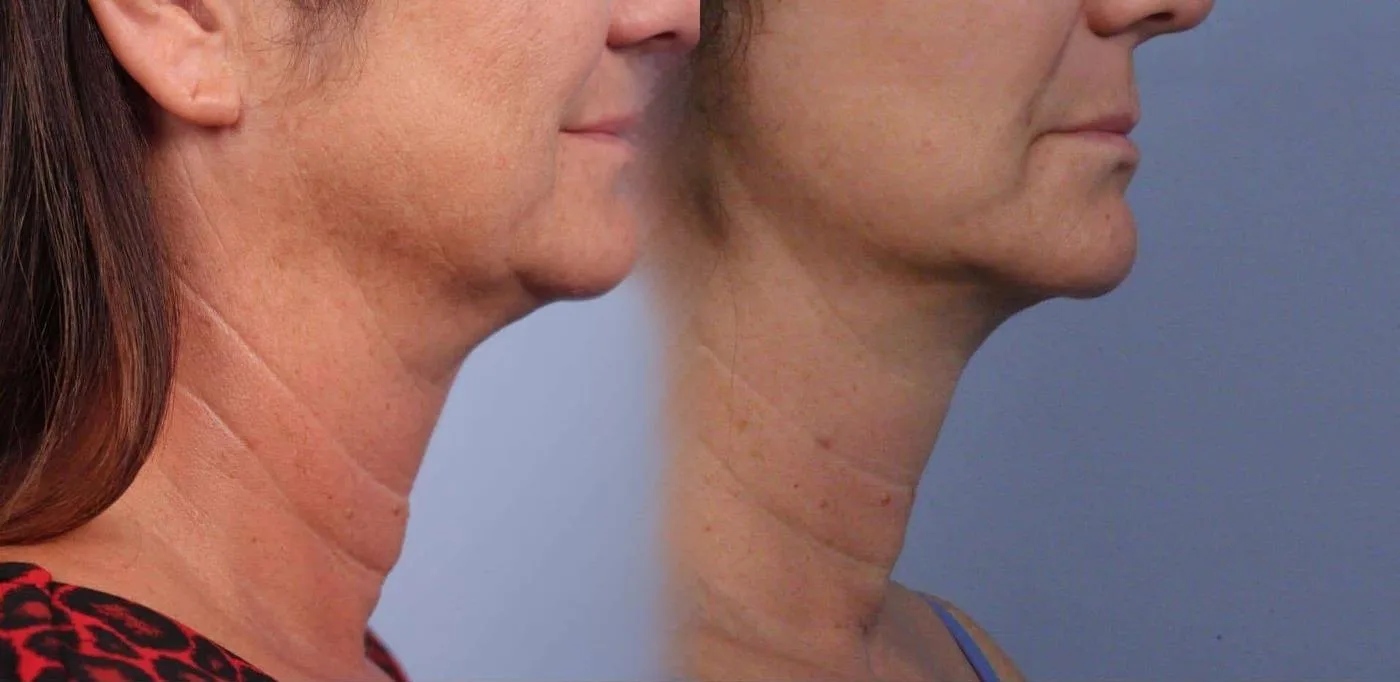Neck Lift - Before and After Gallery - Patient Photo 65