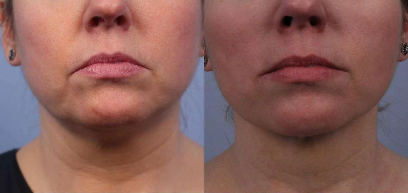 Neck Lift - Before and After Gallery - Patient Photo 66