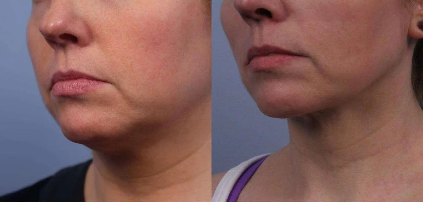Neck Lift - Before and After Gallery - Patient Photo 67