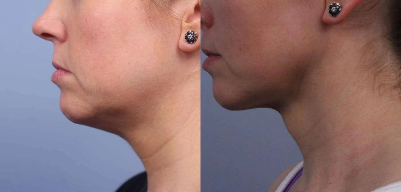 Neck Lift - Before and After Gallery - Patient Photo 68