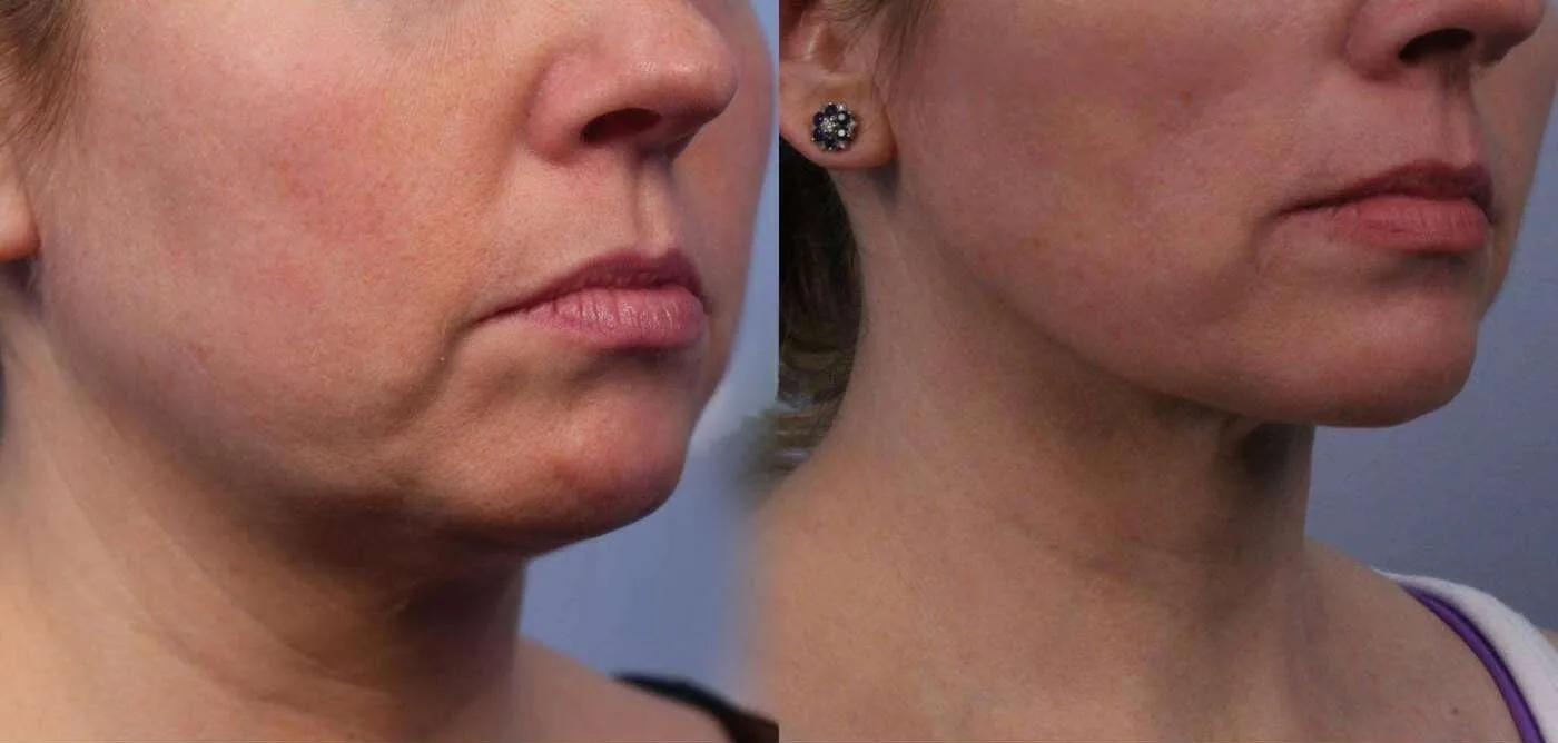 Neck Lift - Before and After Gallery - Patient Photo 68