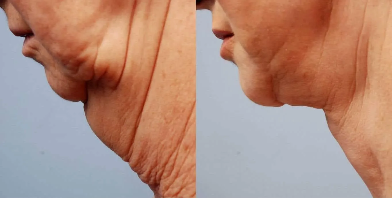 Neck Lift - Before and After Gallery - Patient Photo 7