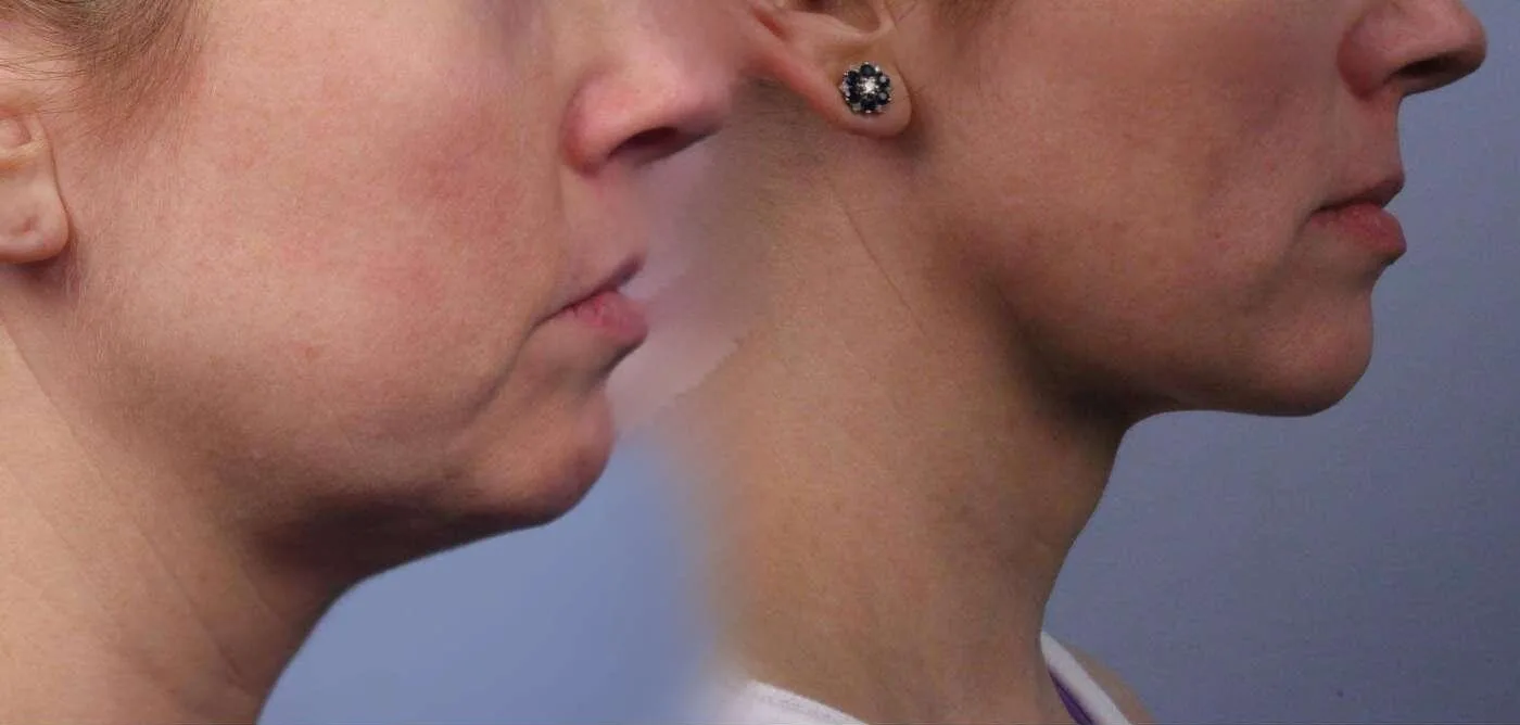 Neck Lift - Before and After Gallery - Patient Photo 70