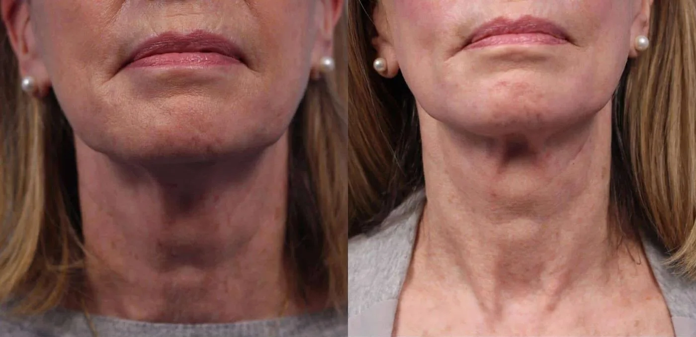 Neck Lift - Before and After Gallery - Patient Photo 71