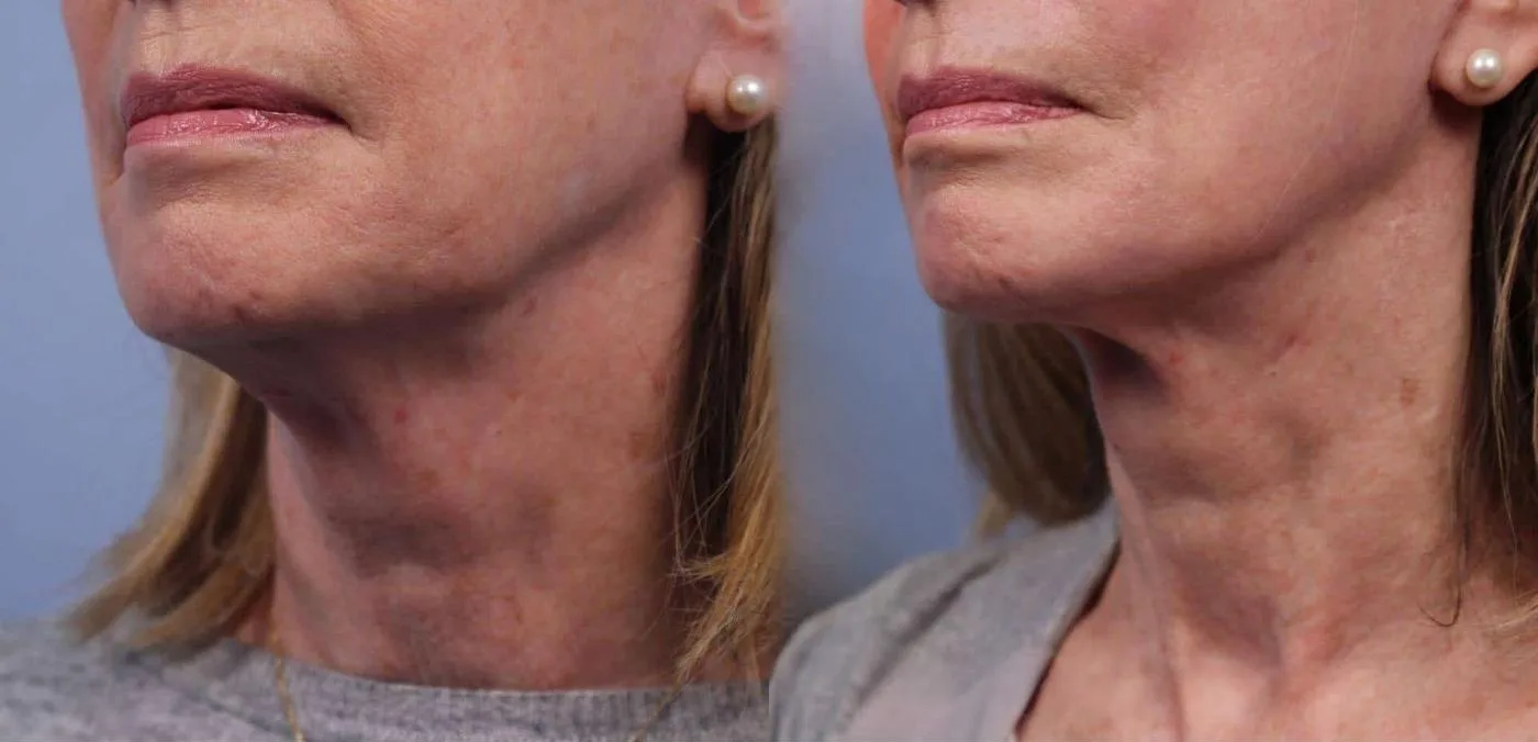 Neck Lift - Before and After Gallery - Patient Photo 72