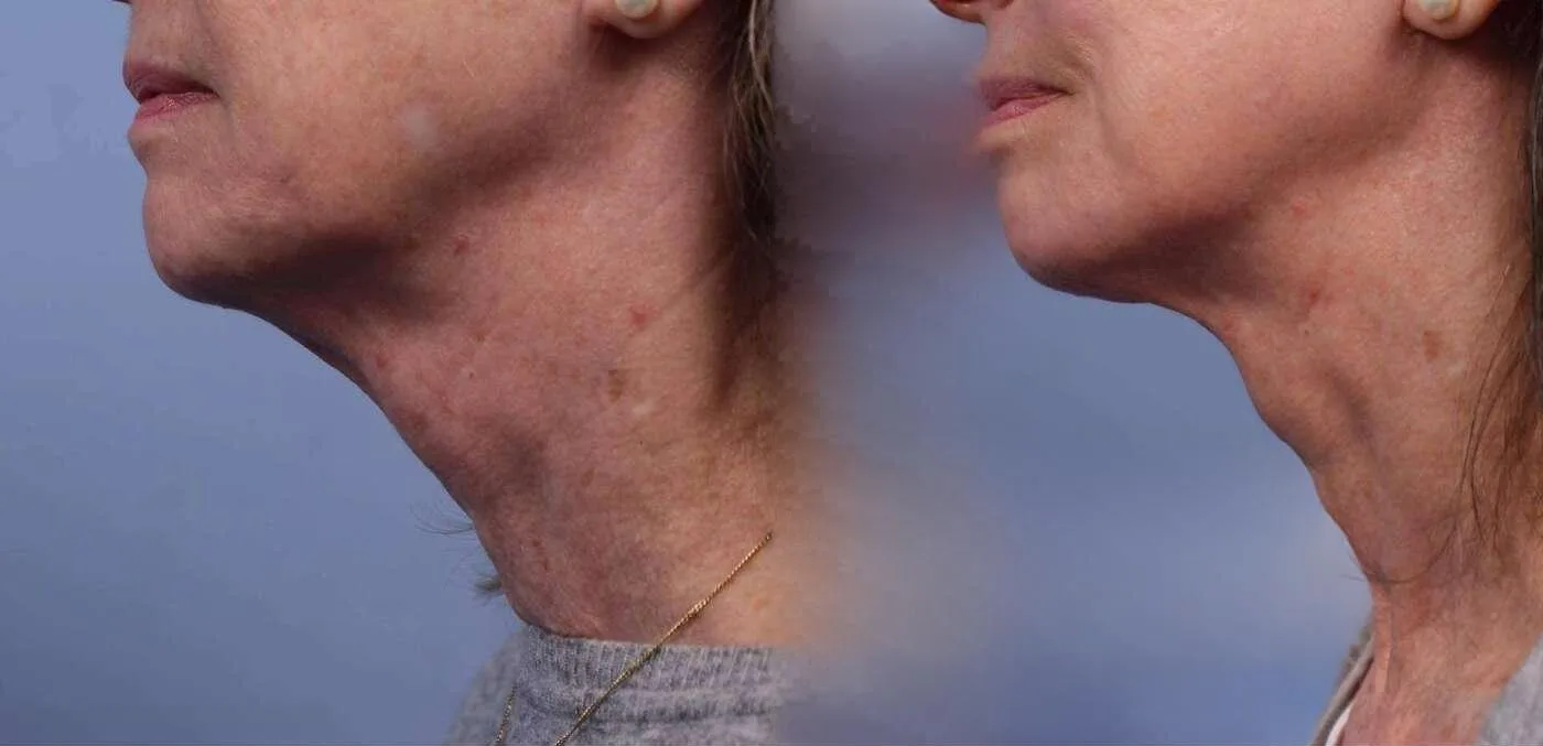 Neck Lift - Before and After Gallery - Patient Photo 73