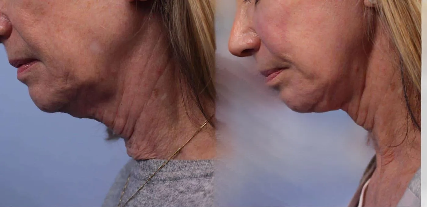 Neck Lift - Before and After Gallery - Patient Photo 74