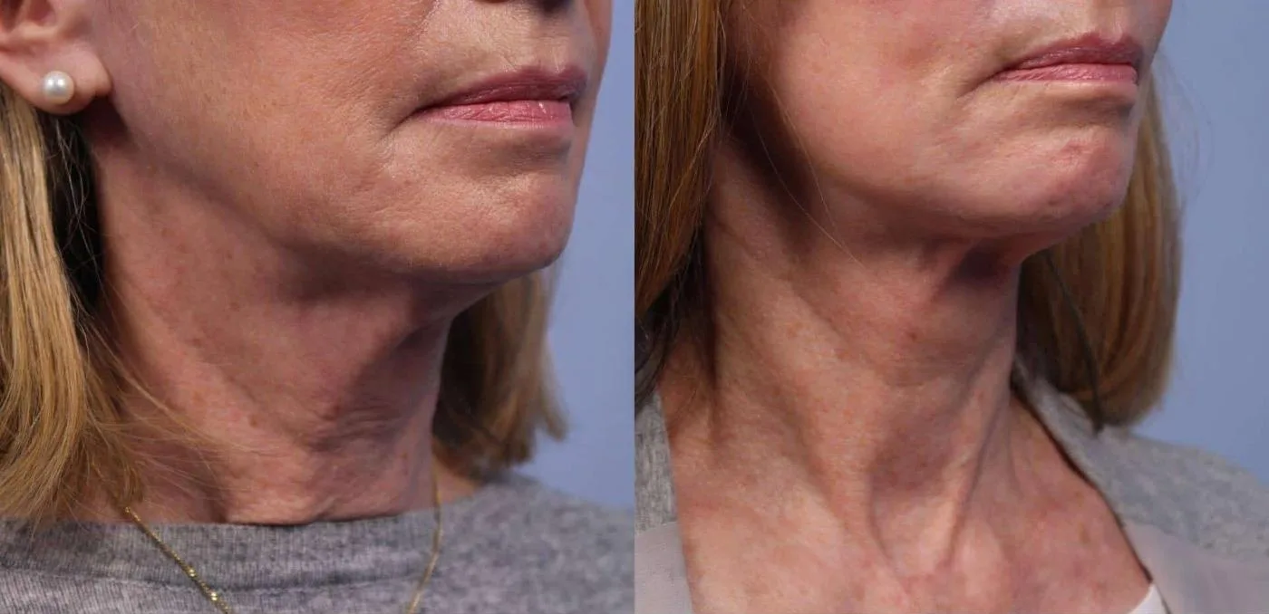 Neck Lift - Before and After Gallery - Patient Photo 75