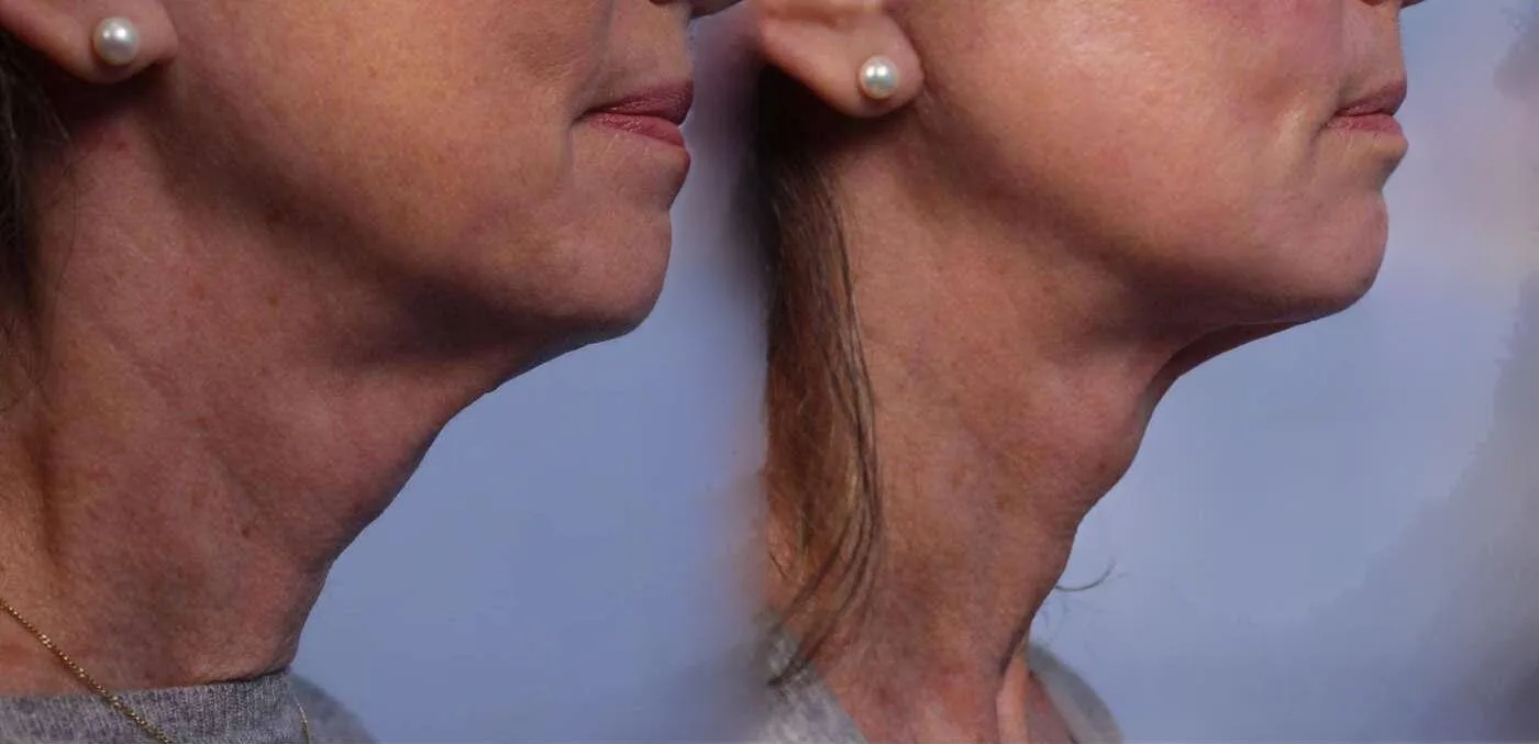 Neck Lift - Before and After Gallery - Patient Photo 76