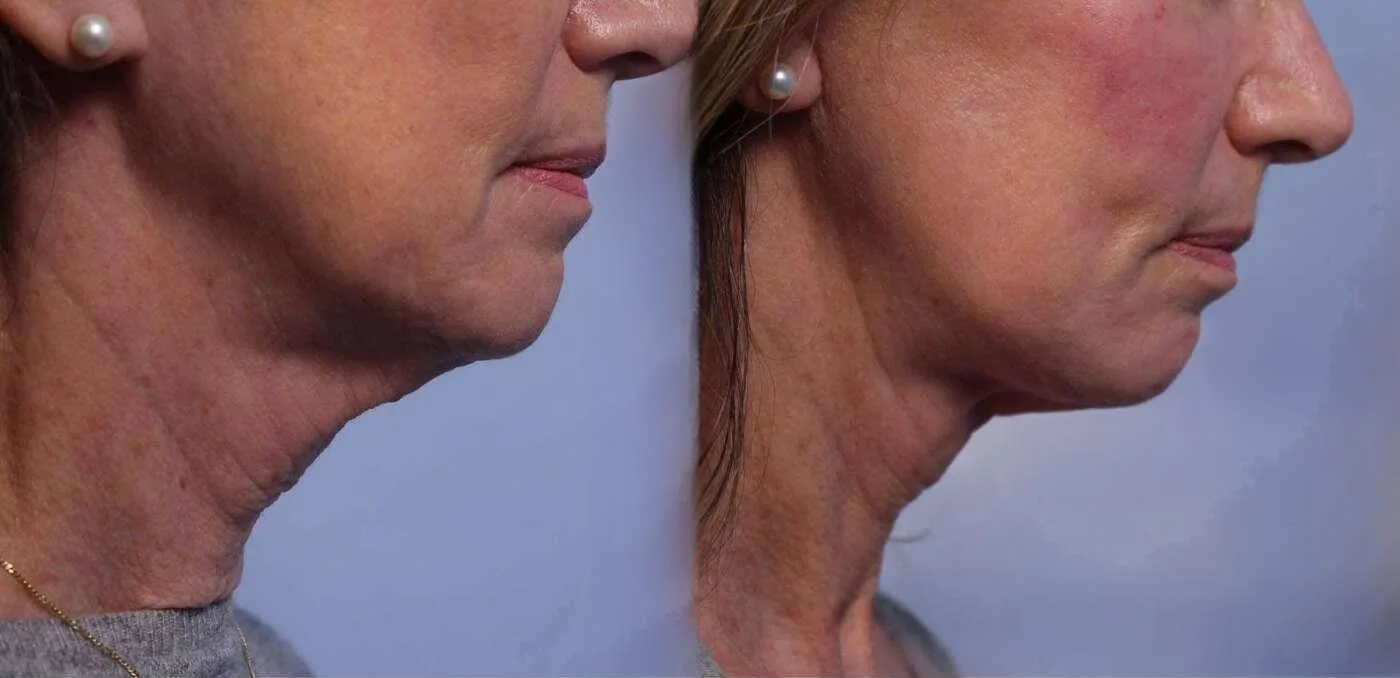 Neck Lift - Before and After Gallery - Patient Photo 77