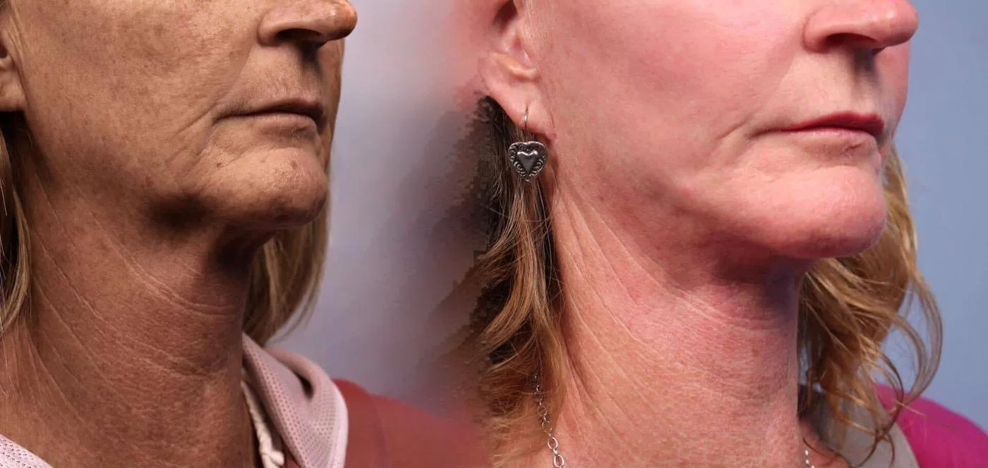 Neck Lift - Before and After Gallery - Patient Photo 78