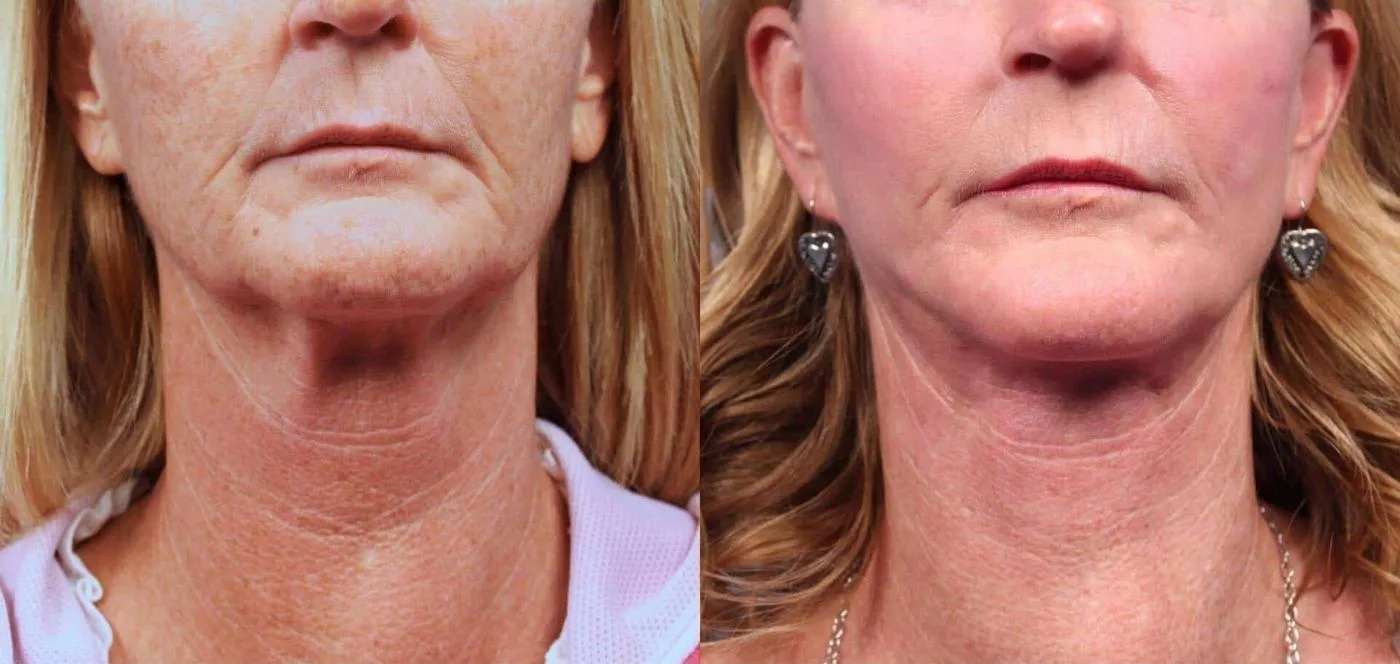 Neck Lift - Before and After Gallery - Patient Photo 79