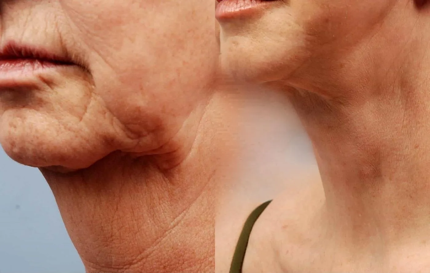 Neck Lift - Before and After Gallery - Patient Photo 8