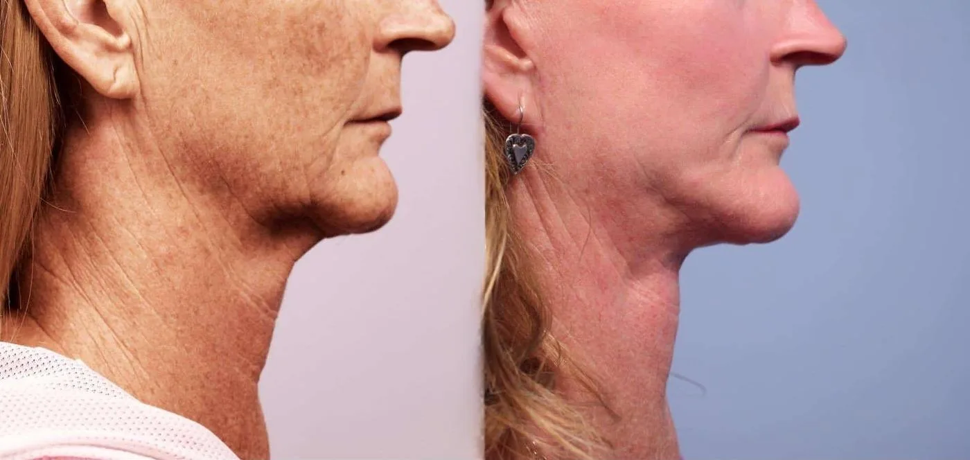 Neck Lift - Before and After Gallery - Patient Photo 80
