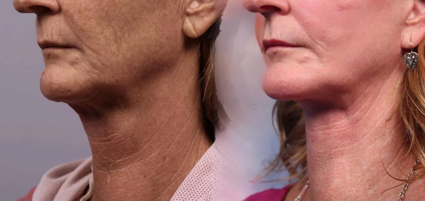 Neck Lift - Before and After Gallery - Patient Photo 81