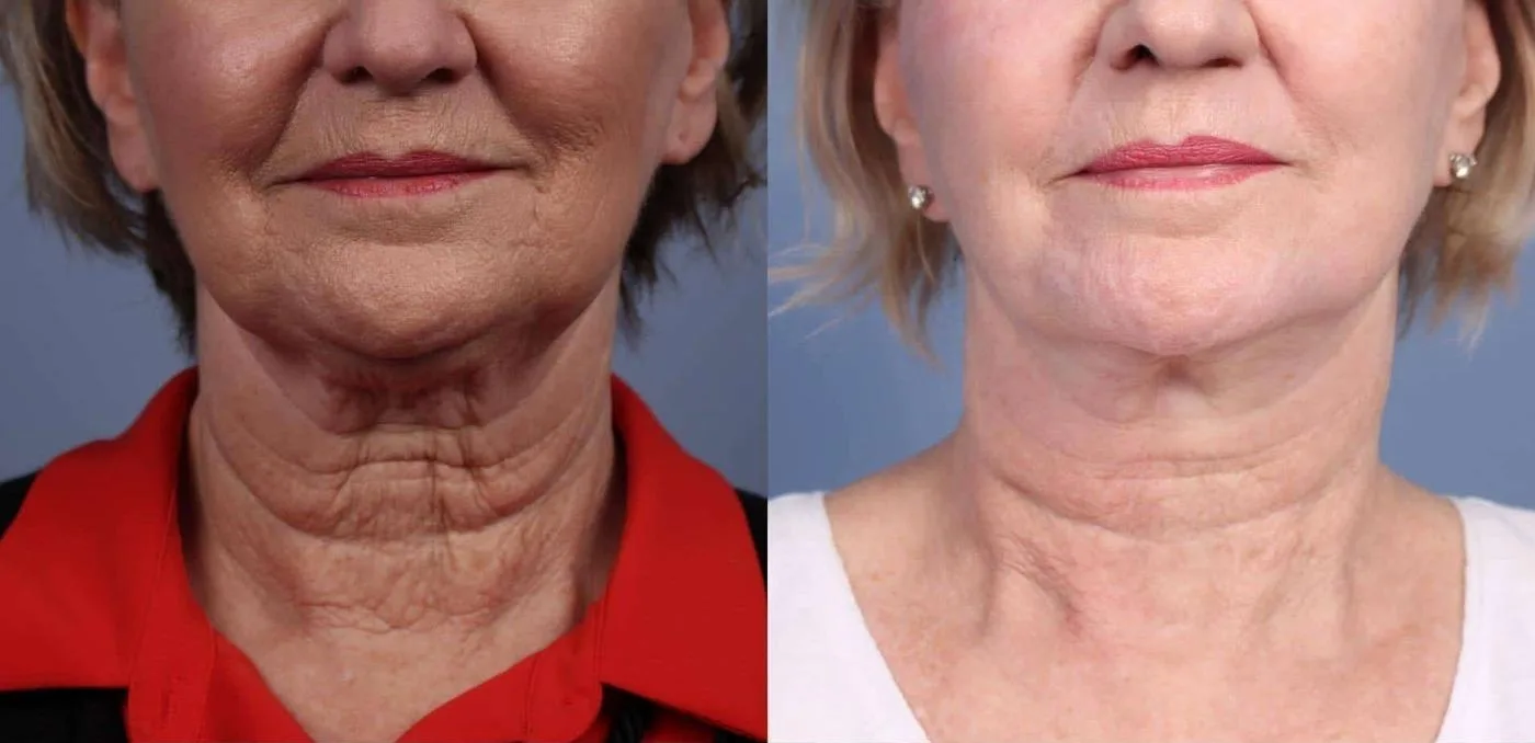 Neck Lift - Before and After Gallery - Patient Photo 82