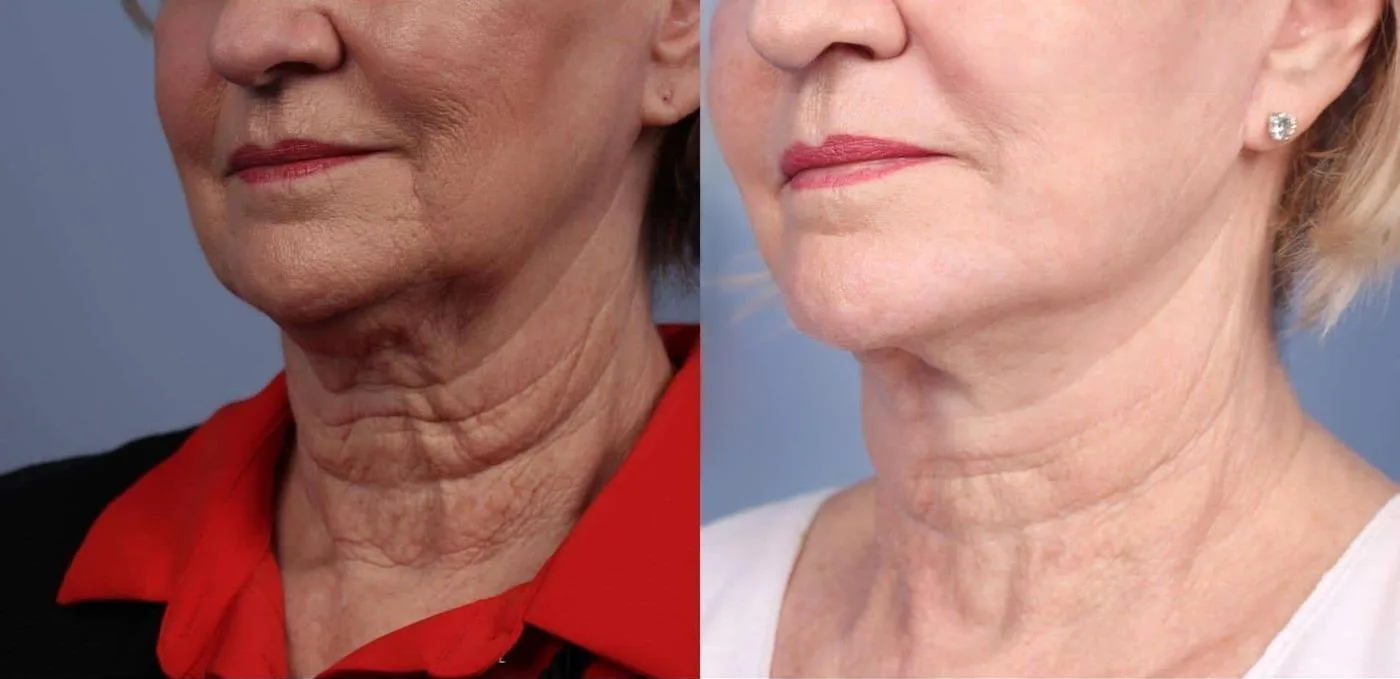 Neck Lift - Before and After Gallery - Patient Photo 83