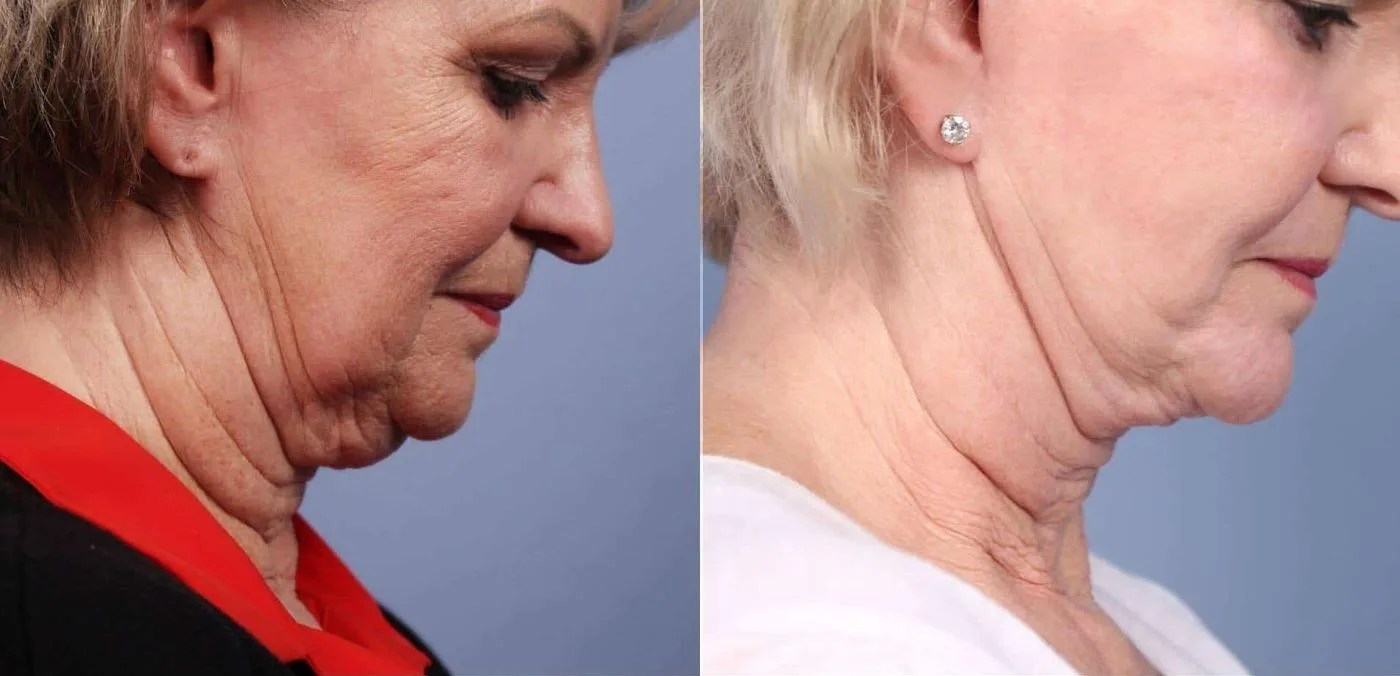 Neck Lift - Before and After Gallery - Patient Photo 86